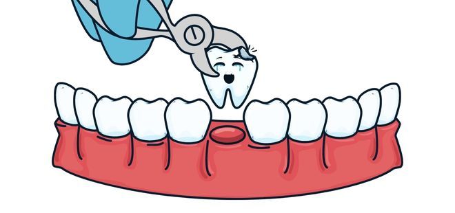 Extracciones dentarias para carga inmediata en Cantillana