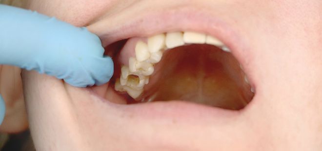 Eliminación de caries en niños.