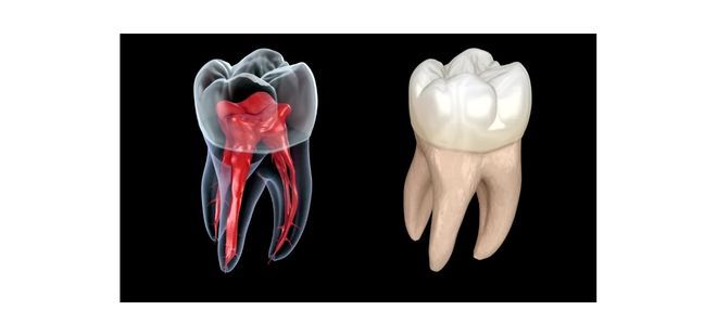 Endodoncia de molar en Cantillana