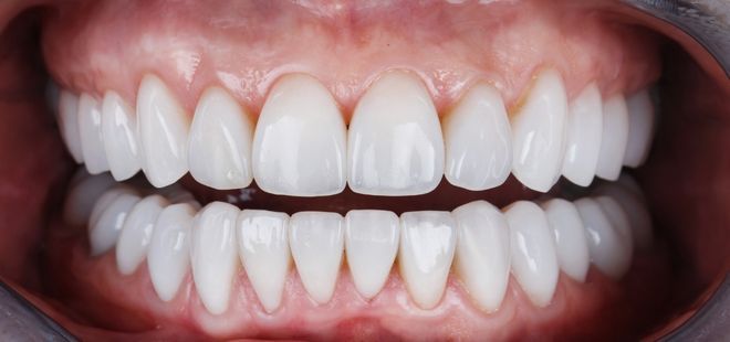 Estética dental, Carillas, en Cantillana.
