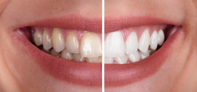 Estetica dental. Blanqueamiento en Cantillana.