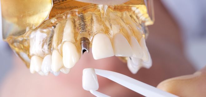 Estética dental. Implantes en Cantillana