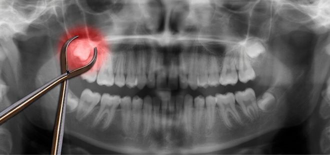 Radiografía extracción muela del juicio.