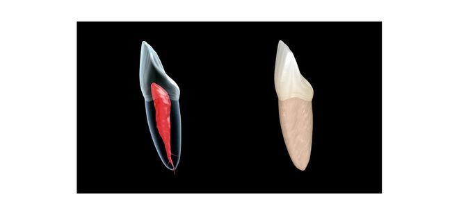 Endodoncia incisivos en Cantillana