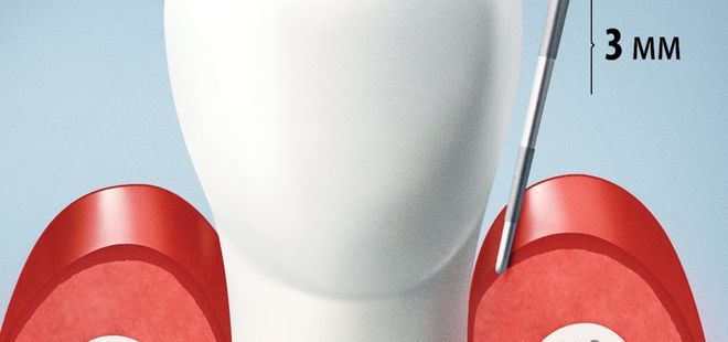 Estudio periodontal. Periodoncia en Cantillana